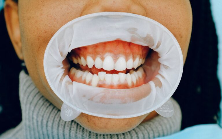 Detailed image of a woman's open mouth during a dental checkup using a cheek retractor.