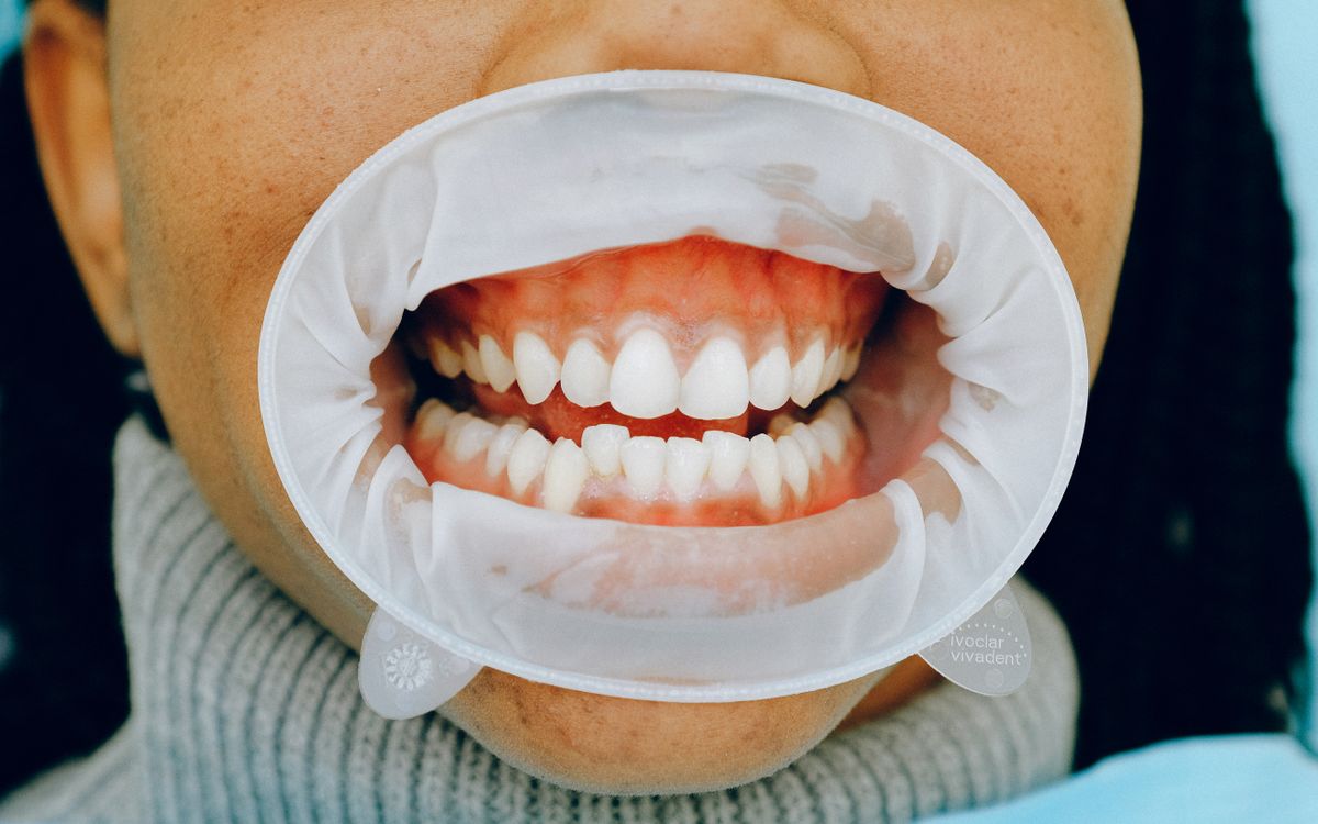 Detailed image of a woman's open mouth during a dental checkup using a cheek retractor.