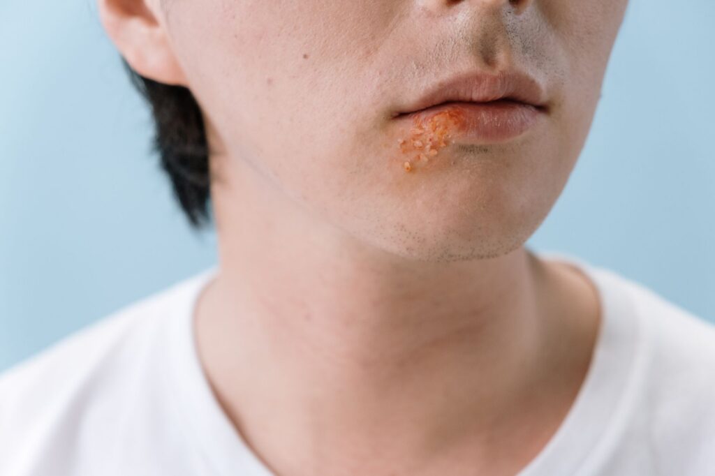 A close-up image of a persons lips showing a cold sore on the lower lip area.