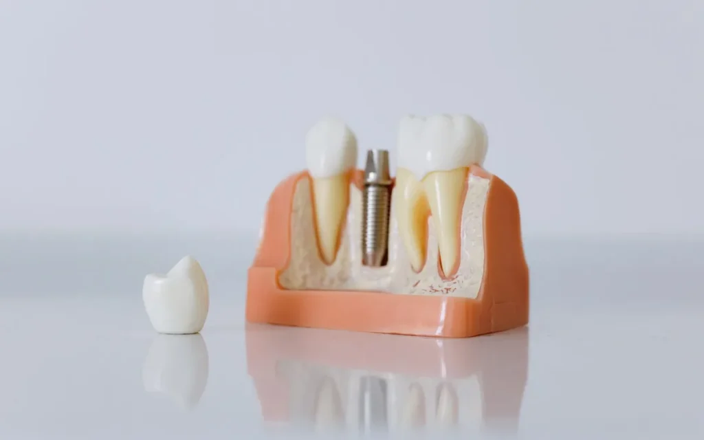Higiena implantu i wizyty kontrolne - jak dbać o odbudowę?